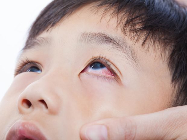 Cẩn trọng bệnh đau mắt đỏ ở trẻ em
